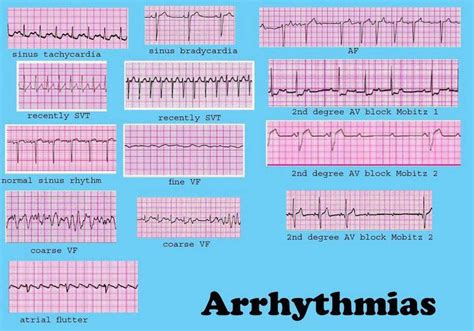 Cardiac Dysrrhythmia (aka Arrhythmia And Irregular Heartbeat ...