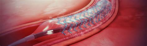 What Is A Better Option For Angioplasty? A Bare Metal Stent Or A Drug ...