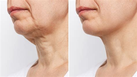 NECK LIFT - 1 SIMPLE SURGICAL PROCEDURE TO ELIMINATE SAGGING CHIN FOREVER