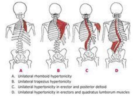 Functional scoliosis #PsoasRelease | Scoliosis exercises, Scoliosis ...