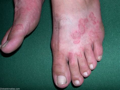 FUNGAL INFECTIONS OF THE SKIN - Podiatry HQ