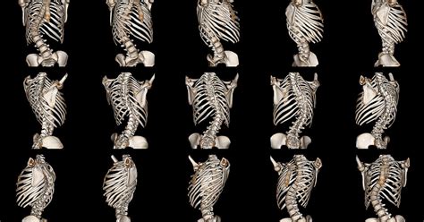 All About Degenerative Scoliosis