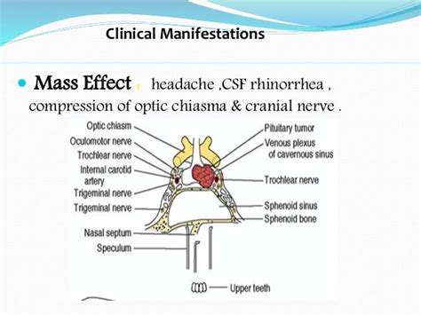 Prolactinoma & men syndromes