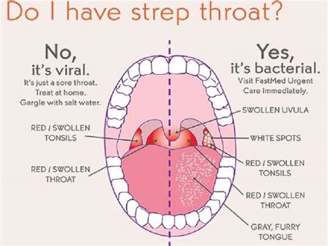 Strep Throat - Is a bacterial infection of the throat and tons