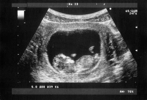 When Is The Baby Visible On A Ultrasound - Baby Viewer