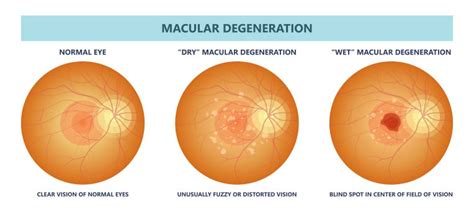 Wet Vs Dry Macular Degeneration: Understand The Differences