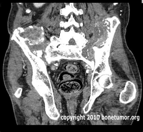 Extensive pelvic metastasis from thyroid cancer | BoneTumor.org