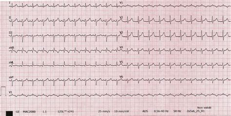 Inappropriate sinus tachycardia or…something else? - Muresan - 2019 ...