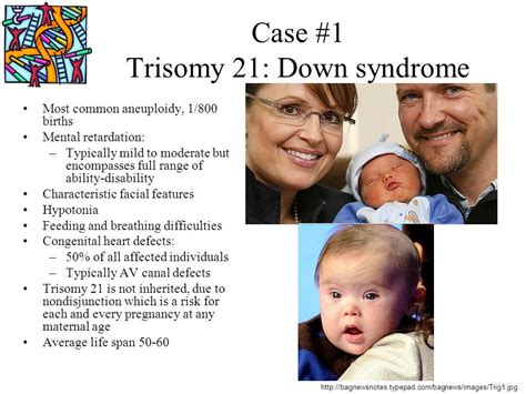 Trisomy 21 Down Syndrome - Down Syndrome (Trisomy 21) : A child with ...