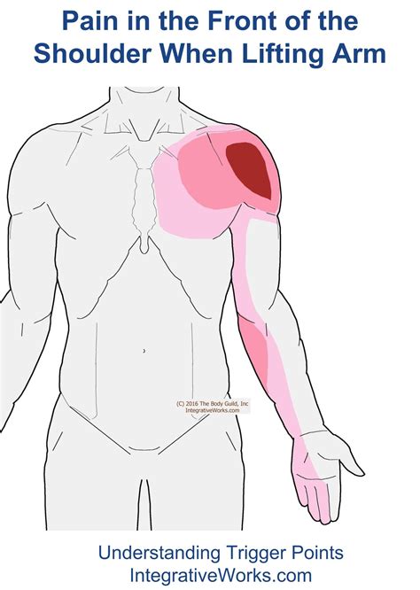 Arm Pain Diagram