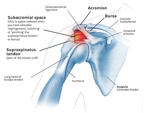 Shoulder impingement cause and treatment with 4 exercises