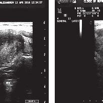 Thyroid ultrasound examination of the thyroid gland -enlarged gland ...