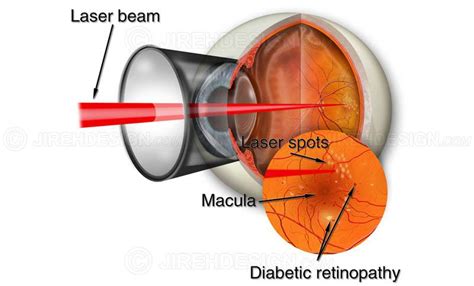 Retinal laser for diabetic retinopathy - #SUVR0003 | Stock eye images