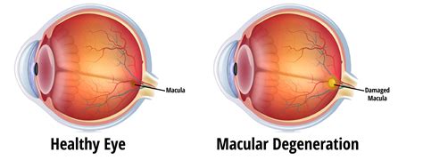 Macular Degeneration – EyeCare Associates of South Tulsa