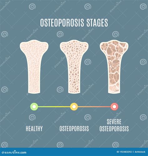 Bone Density DEXA Scan. Osteoporosis Diagnosis. Stock Photography ...