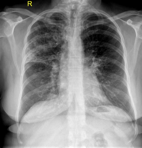 Lobar Pneumonia Chest X Ray