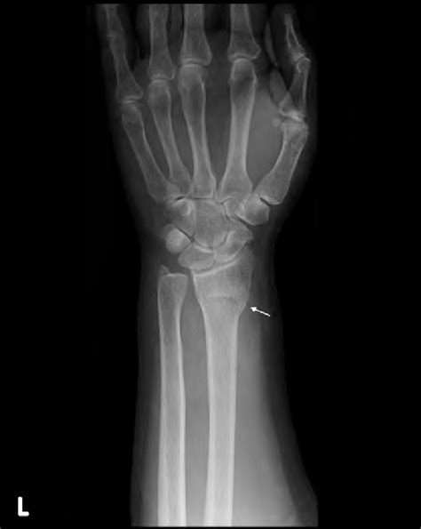 An x-ray showing left distal radius fracture of the patient (arrow ...