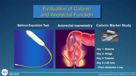 pelvic floor dyssynergia treatment - Emelina Steinberg