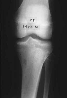 Fibrous Cortical Defect Workup: Imaging Studies, Biopsy, Histologic ...