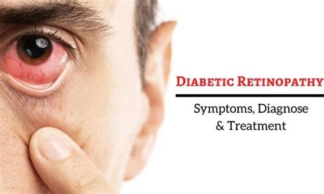 Diabetic Retinopathy: Symptoms, & Treatments | Patient9.com