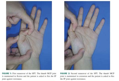 Sesamoid Bone Hand