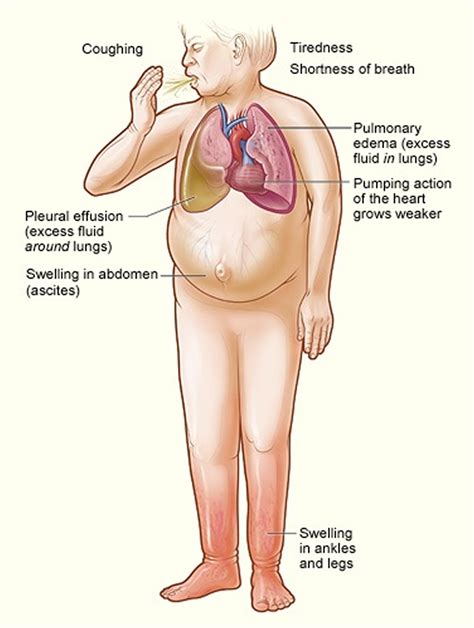 What is Congestive Heart Failure - Stages, Causes, Signs, Symptoms