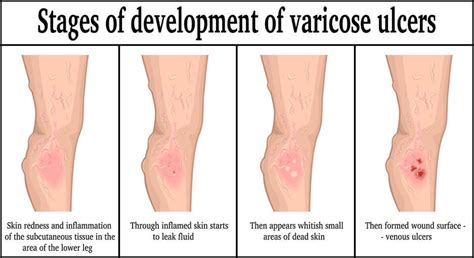 Venous Insufficiency Leg Ulcers - Center for Advanced Cardiac and ...