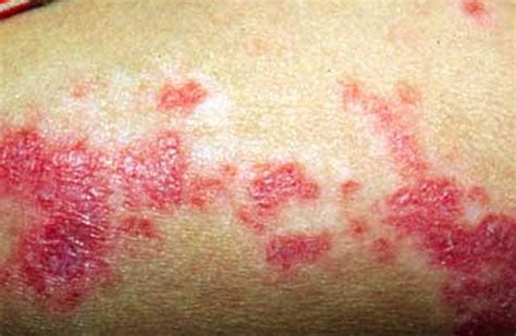 👉 Discoid Lupus - Pictures, Symptoms, Treatment, Causes (December 2021)