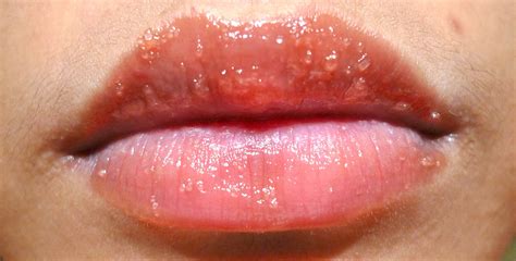 lip rash allergy - pictures, photos