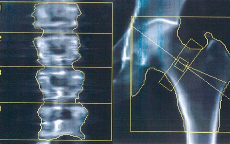 Densitometría Ósea: osteoporosis - Origen, Diagnóstico y traumatología