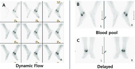 Images of three phase bone scan. A) The flow phase shows increased ...