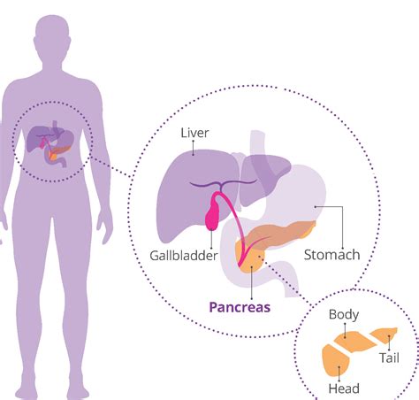 Why We Focus On Early Diagnosis | Pancreatic Cancer Awareness