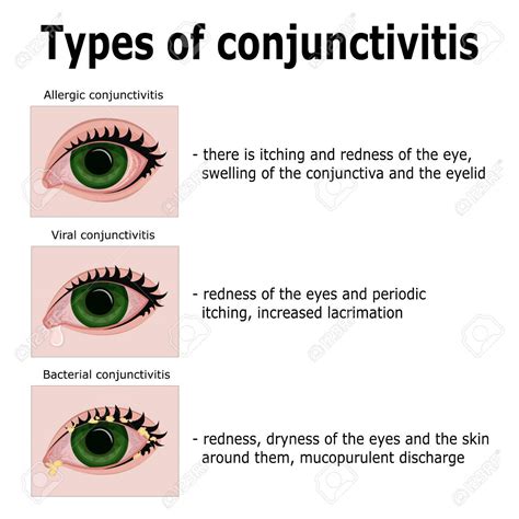 Midtown Optometry - Conjuctivitis (Pink Eye) —Diagnosis And Treatment