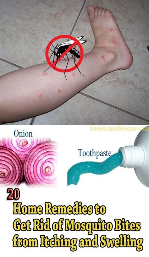 Home Remedies Care — 20 Home Remedies to Get Rid of Mosquito Bites from ...