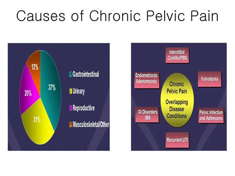 PPT - Chronic Pelvic Pain Pelvic Congestion Syndrome PowerPoint ...