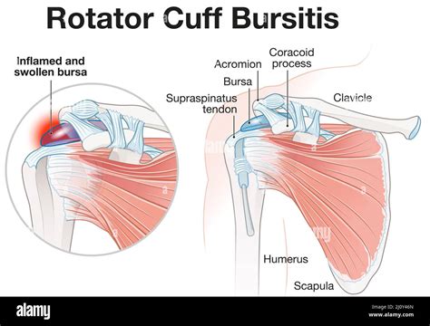 Illustration showing rotator cuff bursitis Stock Photo - Alamy