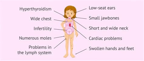 Monosomy Turner Syndrome