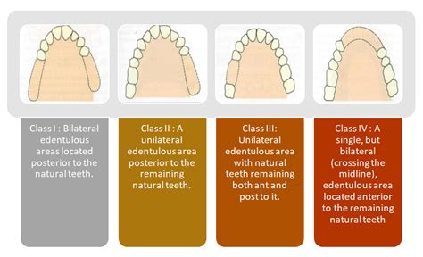 Removable Partial Denture (RPD) - Focus Dentistry