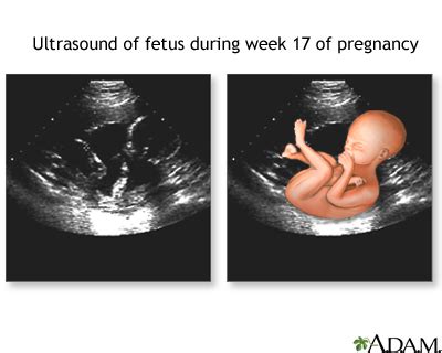 17 week ultrasound: MedlinePlus Medical Encyclopedia Image