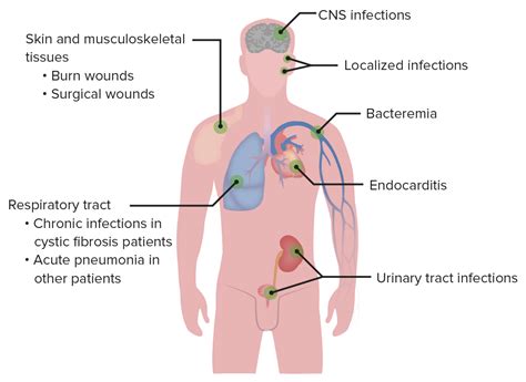 Pseudomonas: Klassifikation & Therapie | Lecturio