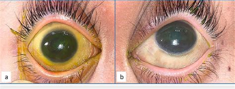 Xerosis Treatment