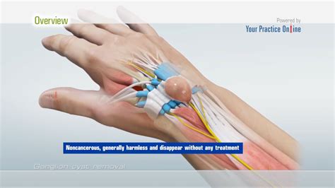 Ganglion Cyst Drainage Cpt - Best Drain Photos Primagem.Org