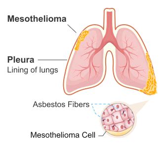 Pleural Mesothelioma | Symptoms, Diagnosis, and Treatment