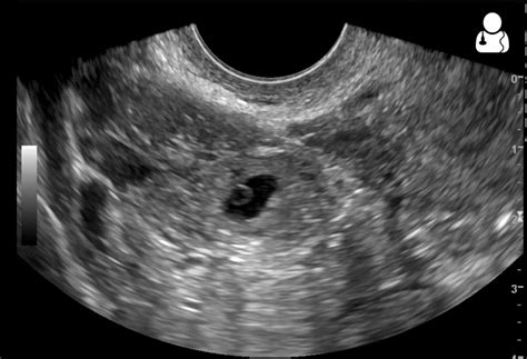 UOTW #61 - Ultrasound of the Week