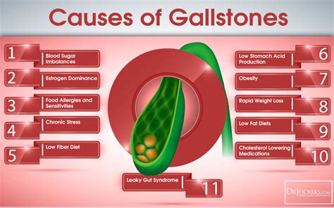 How to Beat GallStones Naturally - DrJockers.com Gallbladder Symptoms, Gallbladder Attack ...