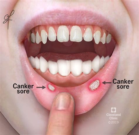 Canker Sore (Aphthous Ulcer): What It Is, Causes & Treatment