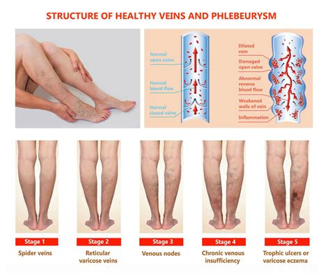 Chronic Venous Insufficiency treated at SCMSC