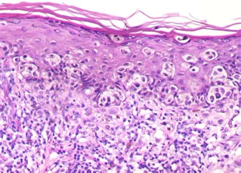 melanoma pathology - pictures, photos