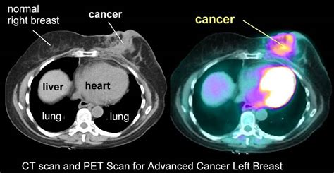 CANCER | Could Cancer be a Metabolic Disease? - Part 2