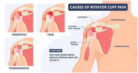 Rotator Cuff Injury & Treatment Options | Advanced Surgery Center